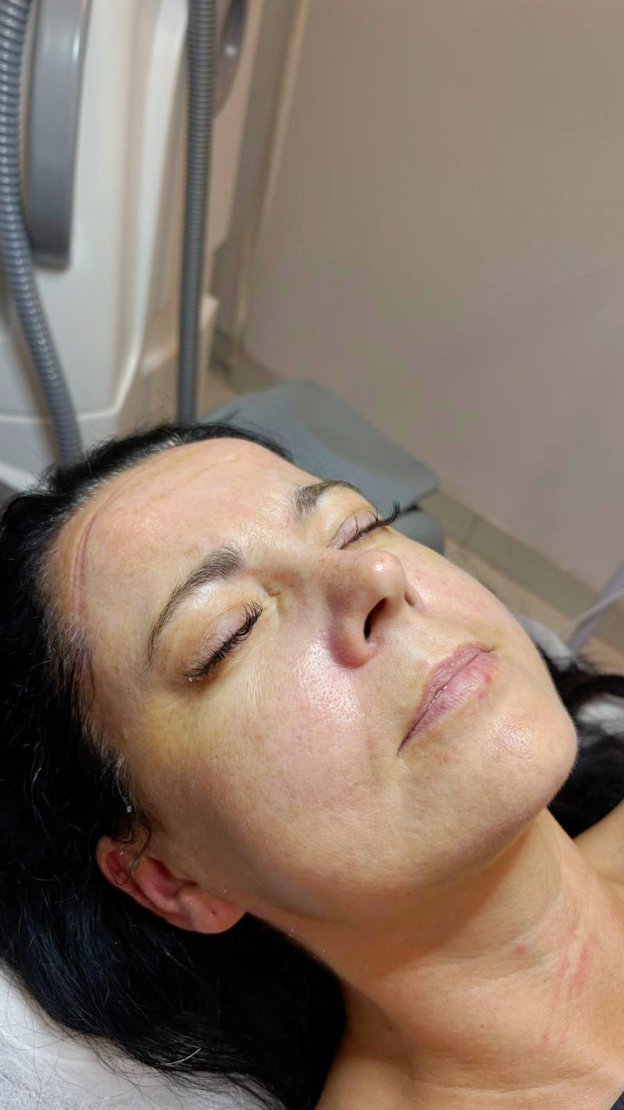 Skóra po peelingu węglowym